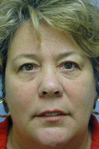 Closeup of a female wearing a red shirt before an endoscopic midface lift procedure showing saggy skin on her forehead and lower eyes