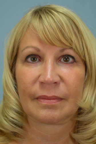 Closeup of a blonde female showing smooth skin in her upper lip area with no visible wrinkles after CO2 laser
