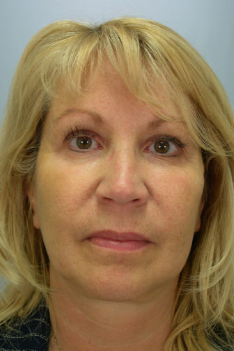 Closeup of a blonde female wearing a black shirt showing wrinkled lines in her upper lip area before CO2 laser procedure