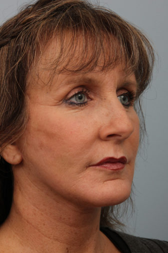 Closeup of a brunette female showing tightly stretched facial skin and firmer neck skin after weekend facelift procedure