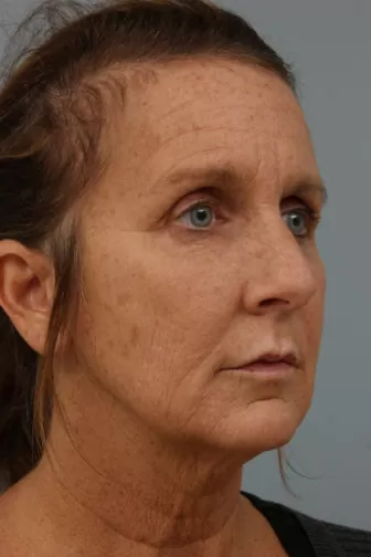 Closeup photo of a female with wrinkles around face and saggy skin on her neck before weekend facelift procedure