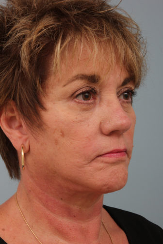 Closeup of a 64 year old female showing firm skin in her lower face after a deep plane facelift procedure