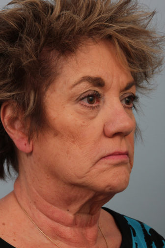 Closeup of a 64 year old female showing deep lines of wrinkles and saggy skin before a deep plane facelift surgery