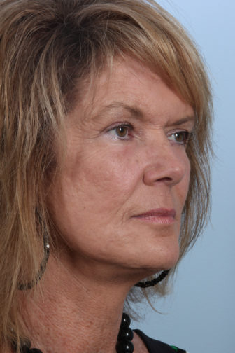 Oblique view of a female wearing a necklace showing firm skin on her face after having facial fat transfer plastic surgery