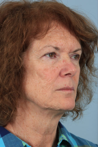 Oblique view of a female with visible saggy neck skin before a facial fat transfer surgery