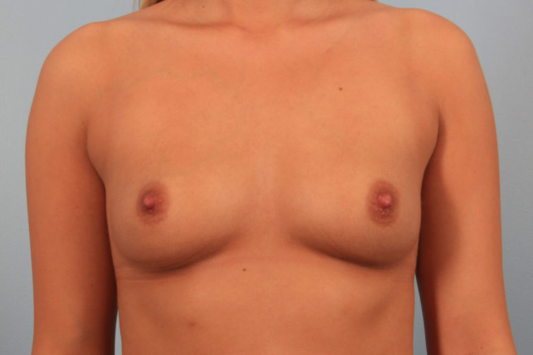 Closeup of a female body showing small breasts before breast augmentation with implants plastic surgery