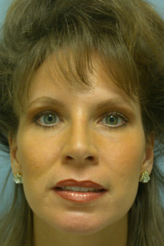 Closeup of a female with tightened skin on her forehead and lower eyes after endoscopic brow/midface lift surgery