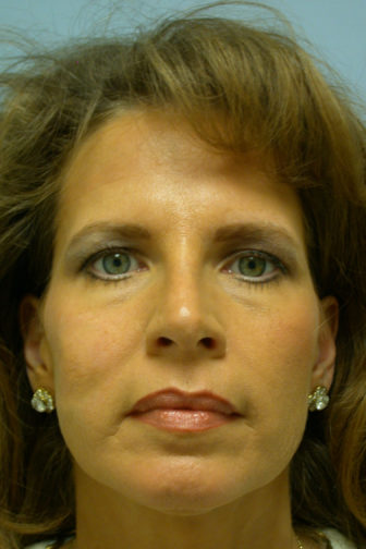 Closeup of a female wearing earrings showing excess skin below her eyes before a endoscopic brow/midface lift