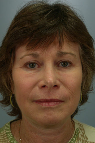 Closeup of a female showing less facial wrinkles and tighten skin from her jowls through her neck after weekend facelift