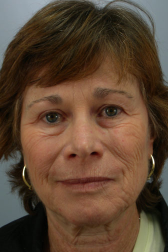 Closeup of a female with gold earrings showing visible wrinkles on her face and loose neck skin before weekend facelift