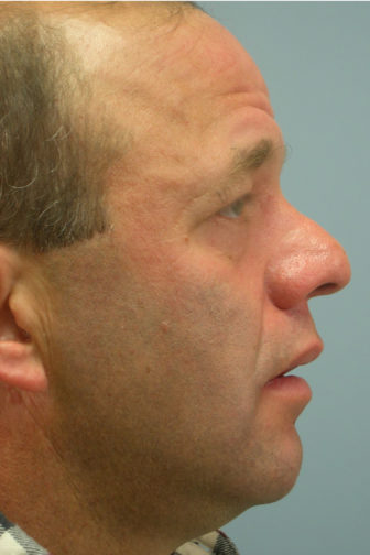 Side profile of a 53 year old male before a revision rhinoplasty surgery showing a crooked nose