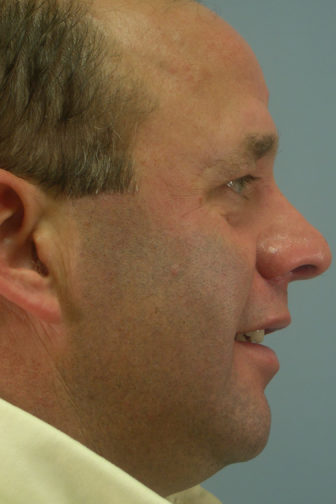 Side profile of a 53 year old male after a revision rhinoplasty surgery showing a smoother and straighten shaped nose