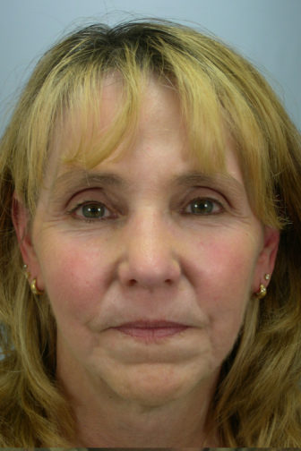Closeup of a female showing smooth skin on her forehead area with minimal wrinkles after CO2 laser surgery