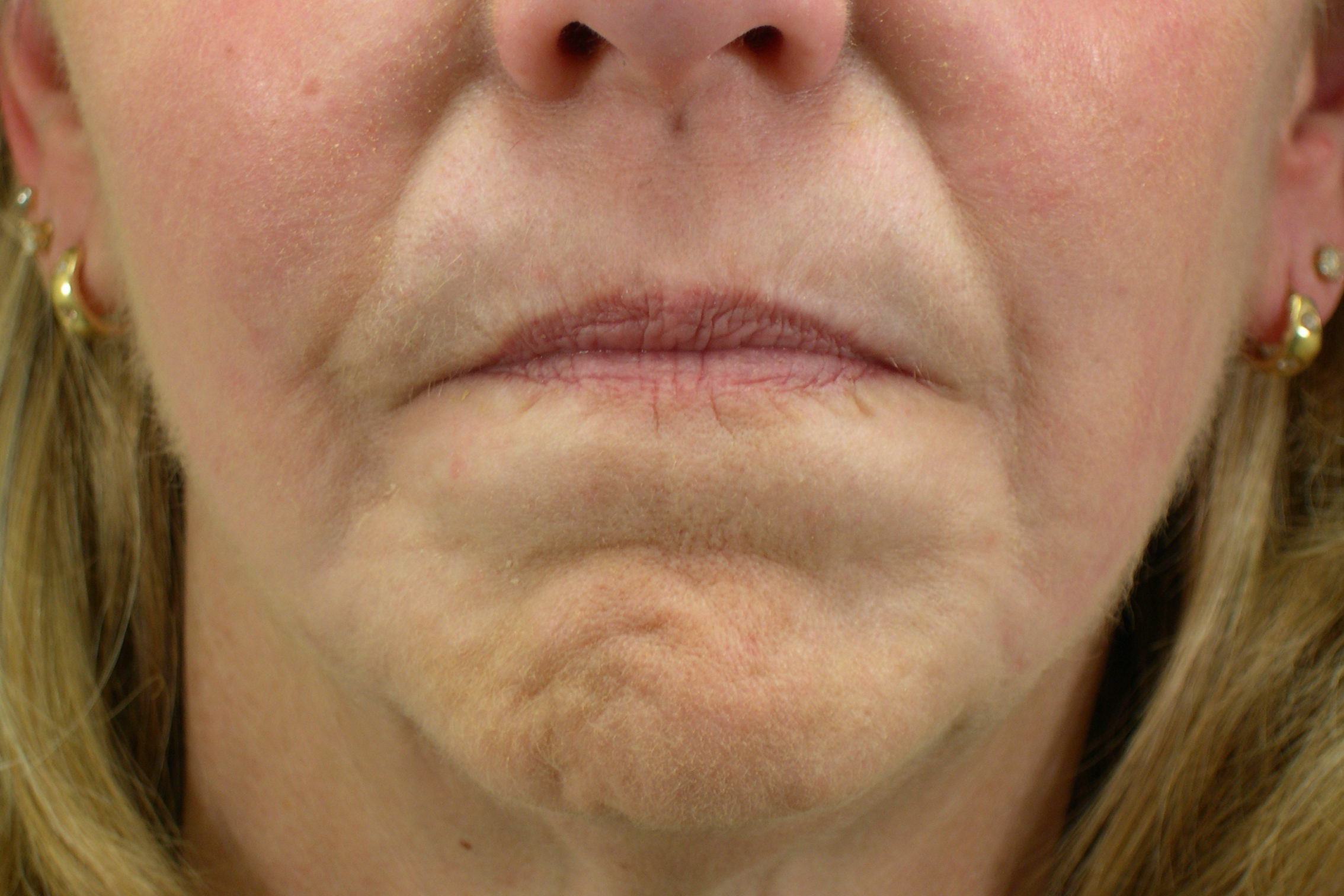 Laser Skin Resurfacing Before & After Photos | Williams Center Williams ...