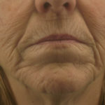 Laser Skin Resurfacing Before & After Photos | Williams Center Williams ...