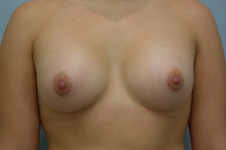 Closeup of a female showing fuller breasts after breast augmentation with implants plastic surgery