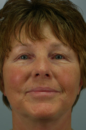 Closeup of a brunette female showing a slimmer neck and tighter cheek and neck skin after a weekend facelift procedure