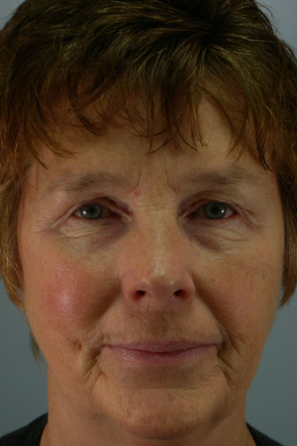 Closeup of a brunette female showing flabby, wrinkled neck and cheek skin before weekend facelift procedure