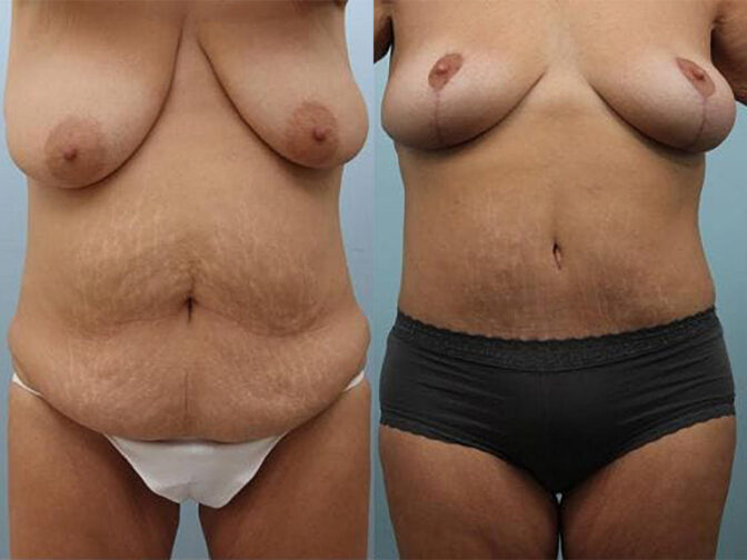 Patient showcasing results of a mommy makeover that included a tummy tuck