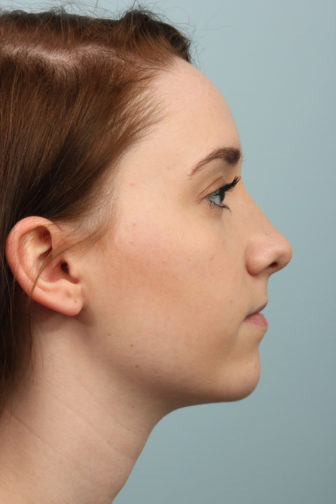 Side profile of a 21 year old female showing a perfect angle of her nose with a smooth shape after rhinoplasty surgery