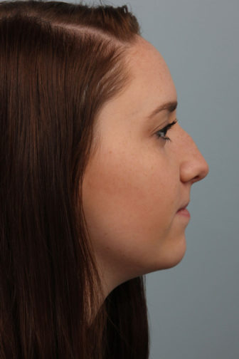 Side profile of a 21 year old female showing a masculine nose before rhinoplasty surgery