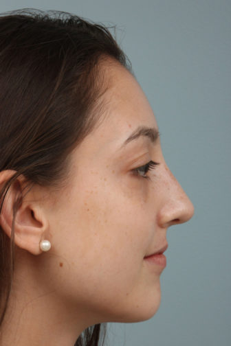 Closeup of a teenage female with brown hair showing a smooth shape of her nose after rhinoplasty surgery