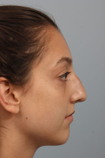 Closeup of a teenage female with brown hair showing a nasal hump before rhinoplasty surgery