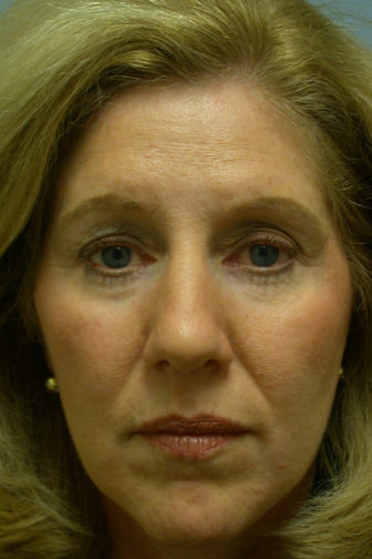 Closeup of a female with compressed skin on her forehead after an endoscopic brow lift surgery making her appear younger