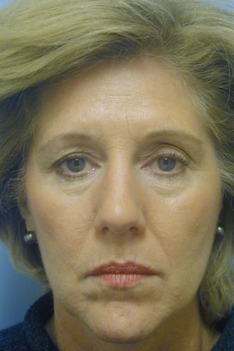 Closeup of female wearing a blue shirt showing saggy skin on her forehead and upper eyes before endoscopic brow lift surgery