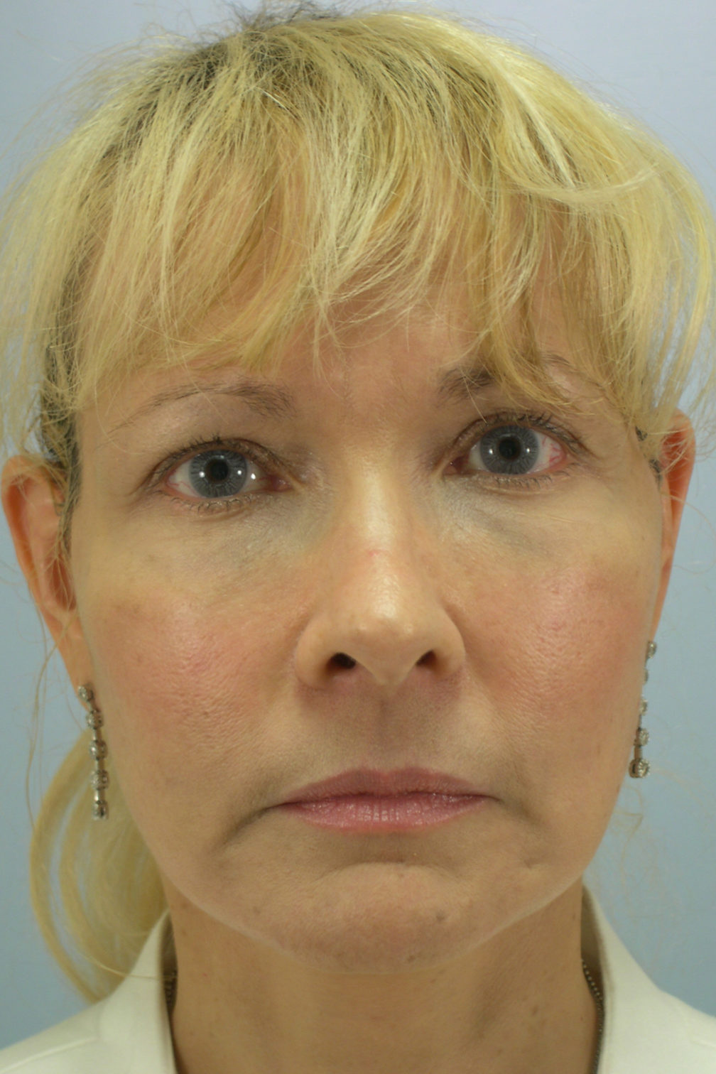 Facial Fat Transfer Surgery Pictures Williams Center Williams Center