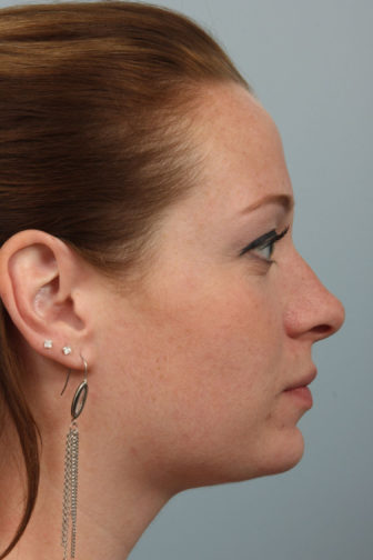 Closeup of a female with brown hair showing an upright angle of her nasal tip after an endonasal rhinoplasty surgery