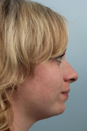 Closeup of a blonde female with a drooping nasal tip and hanging columella before endonasal rhinoplasty surgery