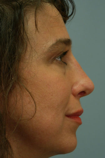 Closeup of a female with black hair showing an upright angle and narrow tip of her nose after a rhinoplasty surgery