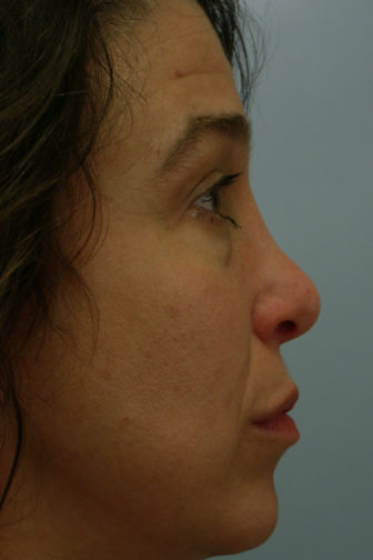 Closeup of a female with jet black hair showing a wide and bent angle of her nose before a rhinoplasty surgery