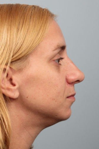 Closeup of a female wearing a black shirt showing well-proportioned nose angle after a revision rhinoplasty surgery