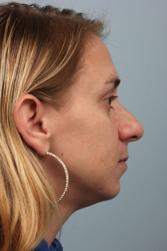 Closeup of a female wearing gold hoop earrings showing misshapen angle of her nose before revision rhinoplasty surgery