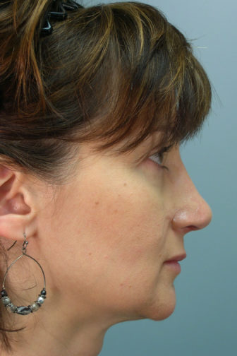 Side profile of a female showing a straighter nose after a revision rhinoplasty surgery