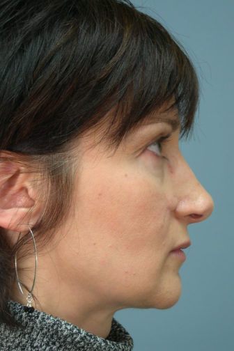 Side profile of a female showing a droopy nasal tip with excess cartilage before revision rhinoplasty