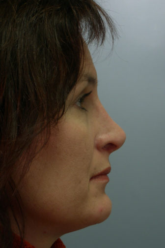 Closeup of a female showing straighter shape of her nose after nasal reconstructive rhinoplasty plastic surgery