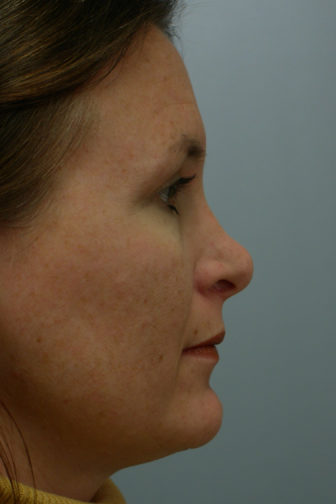 Closeup of a female wearing yellow shirt showing deformed shape of her nose before nasal reconstructive surgery