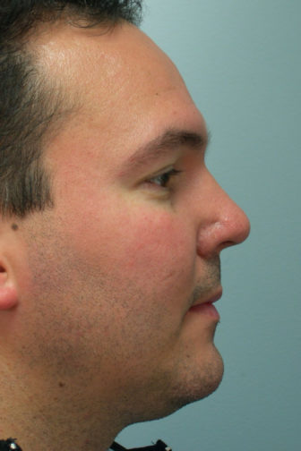 Closeup of a male with a black jacket showing an upright pointed angle of his nose after revision rhinoplasty surgery