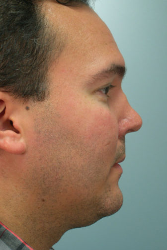 Closeup of a male with a polo shirt showing deformed shape and concave angle of his nose before revision rhinoplasty