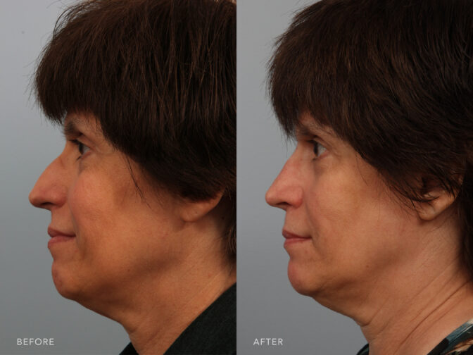 Side by side before and after of a middle aged woman who had Rhinoplasty surgery in Albany, NY. Her nasal hump was removed and her nose is smaller and more feminine. | Albany, Latham, Saratoga NY, Plastic Surgery