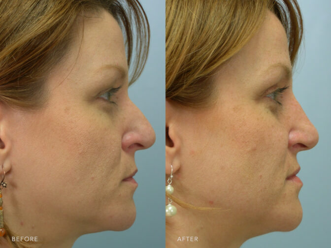 Side by side before and after rhinoplasty surgery in Albany, NY. Her nasal bridge was shaved down and her nose is much straighter and smaller. | Albany, Latham, Saratoga NY, Plastic Surgery