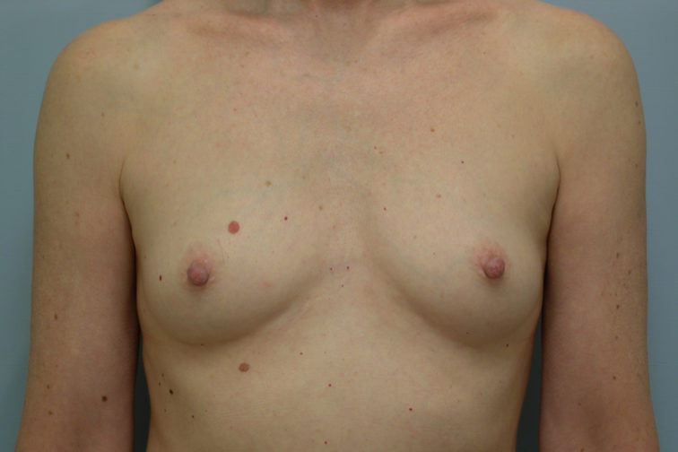 Closeup of a female showing small, A-cup breasts before having breast augmentation and implant plastic surgery