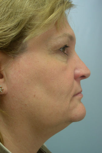Closeup of a female wearing earrings with loose skin on her jowls and flabby neck skin before weekend facelift procedure