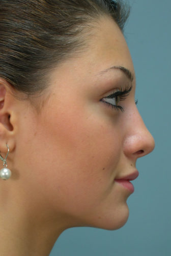 Closeup of a female with black hair showing a straight and upright angle of her nose after rhinoplasty surgery