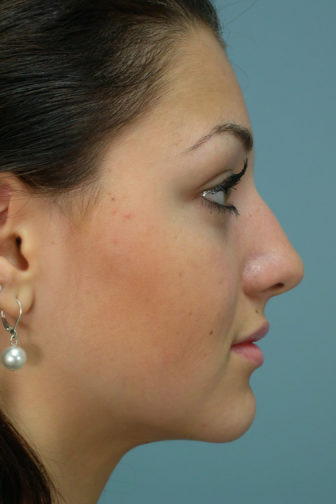 Closeup of a female with black hair showing a misaligned angle and bent nose before a rhinoplasty plastic surgery