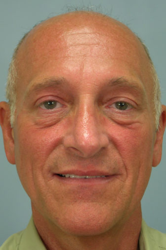 Closeup of a male showing tighten skin around his eyelids after an upper eyelid and endoscopic forehead lift surgery