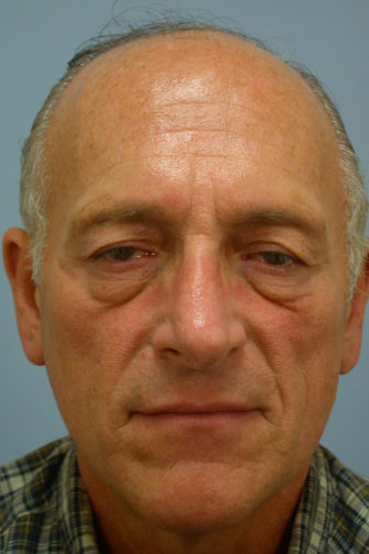 Closeup of a male showing heavy bags around his eyes before an upper eyelid and endoscopic forehead lift